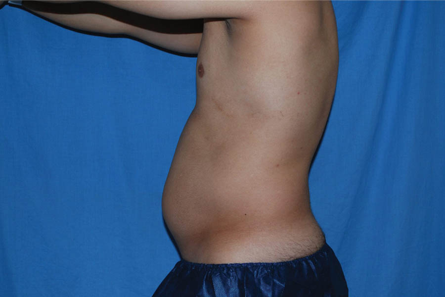 Liposuction case #4716