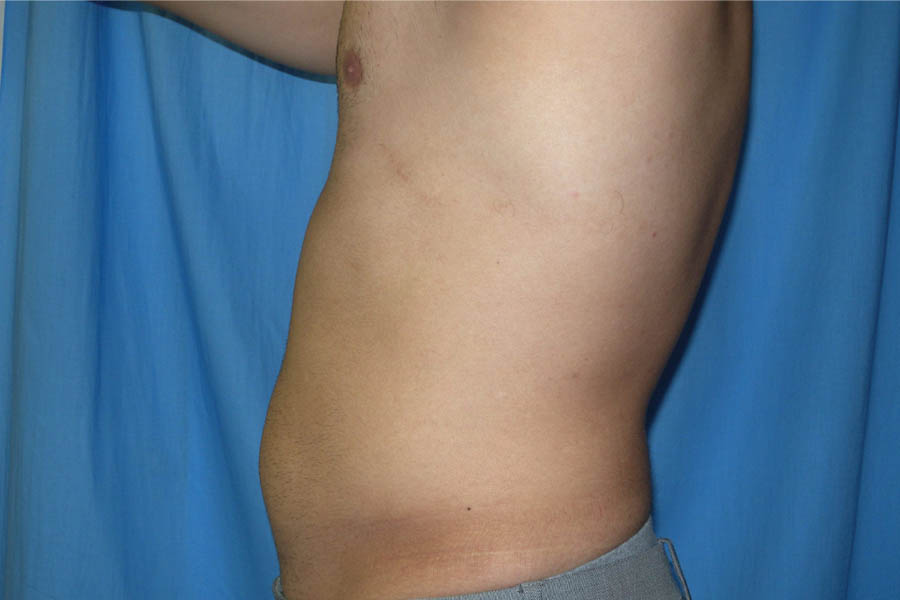 Liposuction case #4716