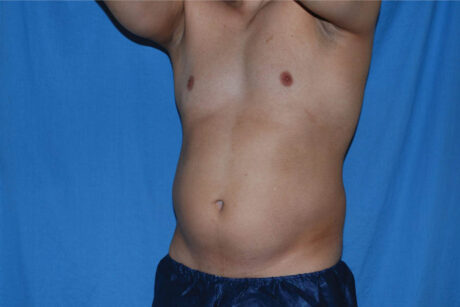 Liposuction case #4716