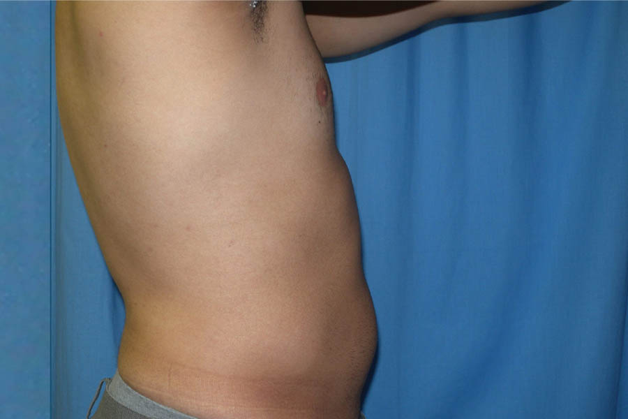 Liposuction case #4716