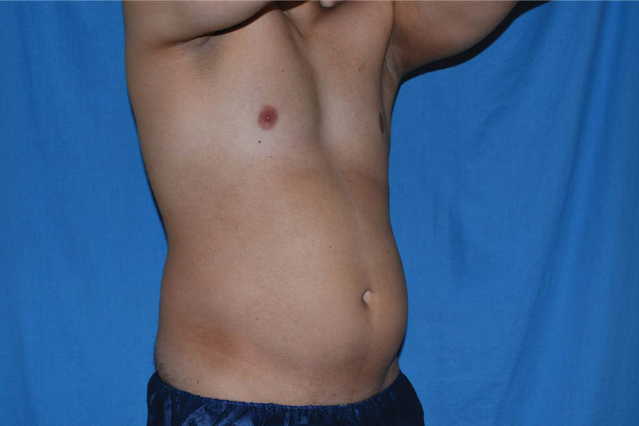 Liposuction case #4716