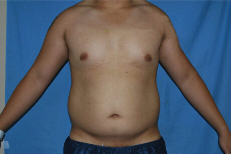 Liposuction case #4725