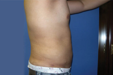 Liposuction case #4725