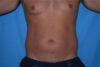 Liposuction case #4736