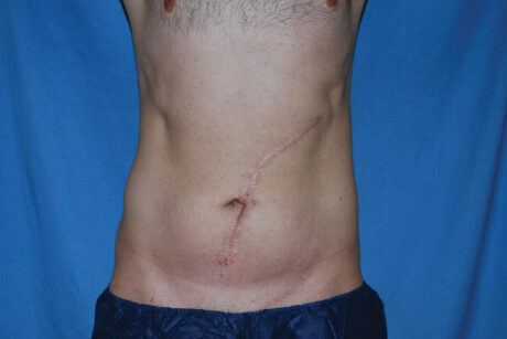 Liposuction case #4748