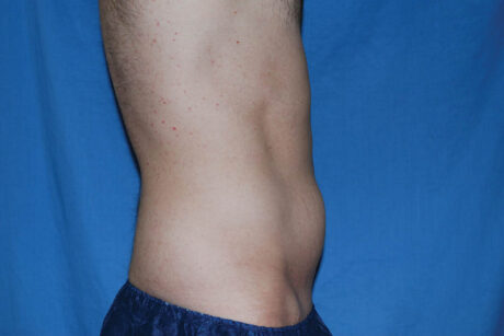 Liposuction case #4748