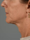 Facelift case #11414