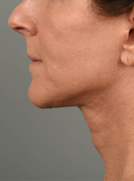 Facelift case #11414