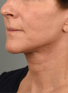 Facelift case #11414