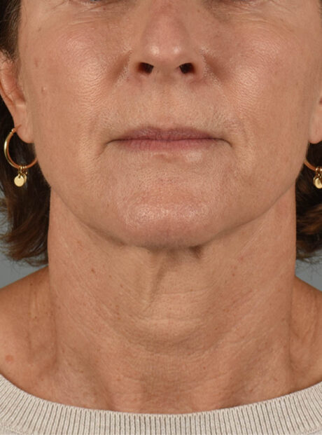 Facelift case #11414