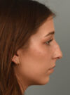 Chin Augmentation case #11702