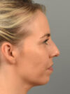 Chin Augmentation case #11717