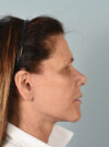 Facelift case #11430